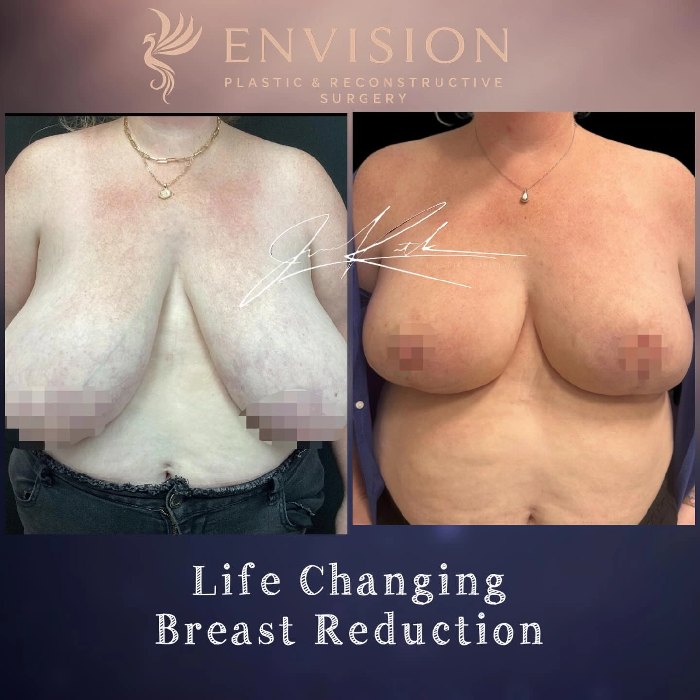 Breast reduction before-and-after comparison.