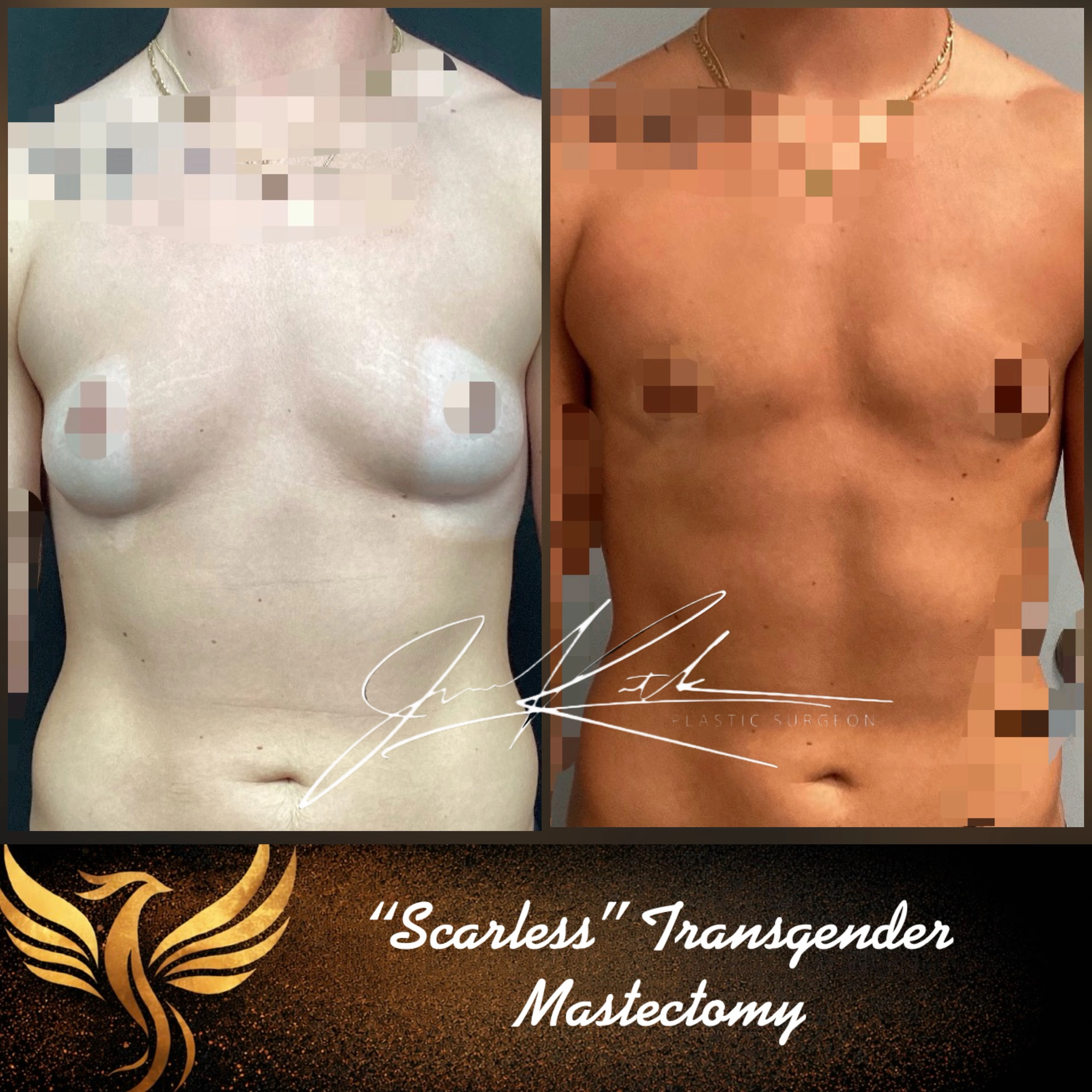 Chest masculinization before-and-after comparison.