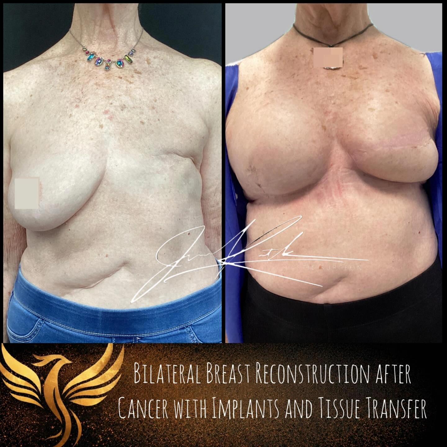 Before-and-after comparison of combined flap and implant breast reconstruction.