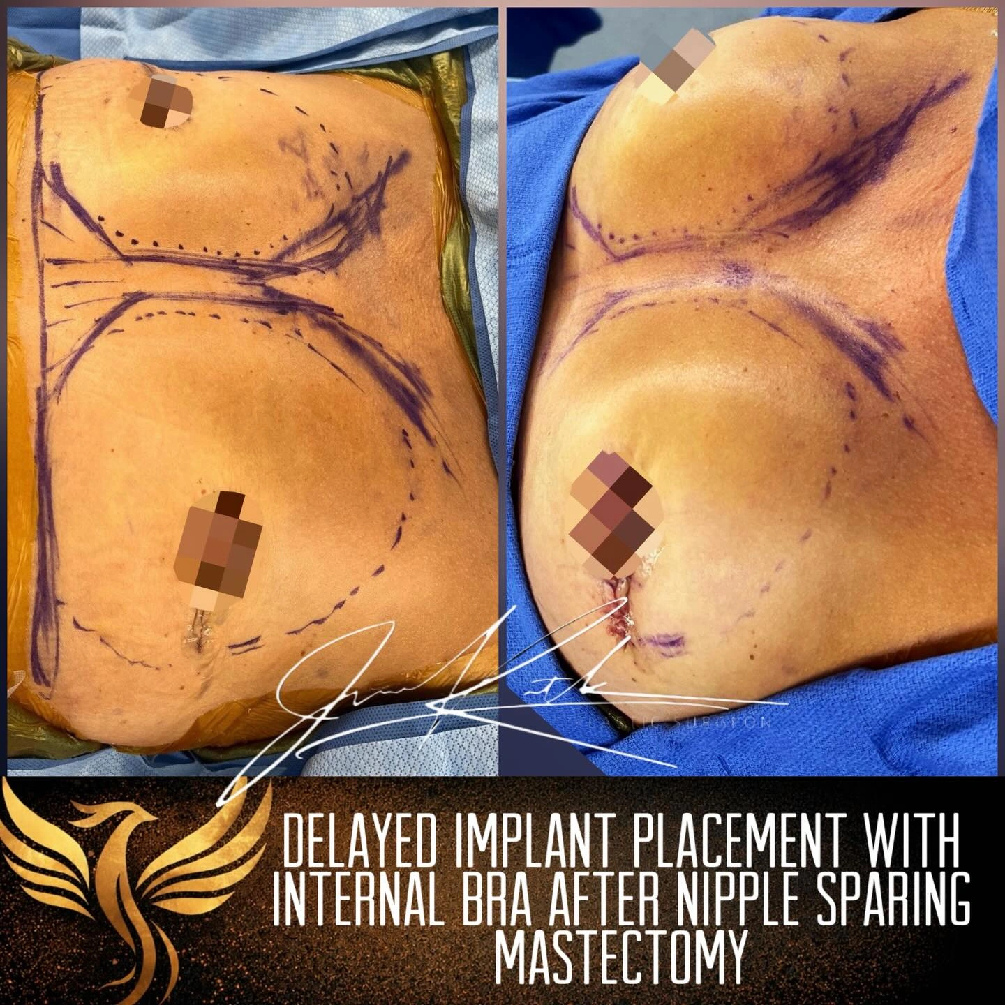 Delayed implant placement with internal support after nipple-sparing mastectomy. Original clinical comparison from Envision Plastic Surgery.