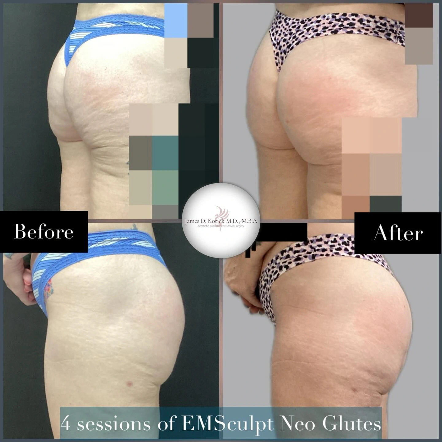 EMSCULPT NEO glutes · After four sessions. Original clinical comparison from Envision Plastic Surgery.
