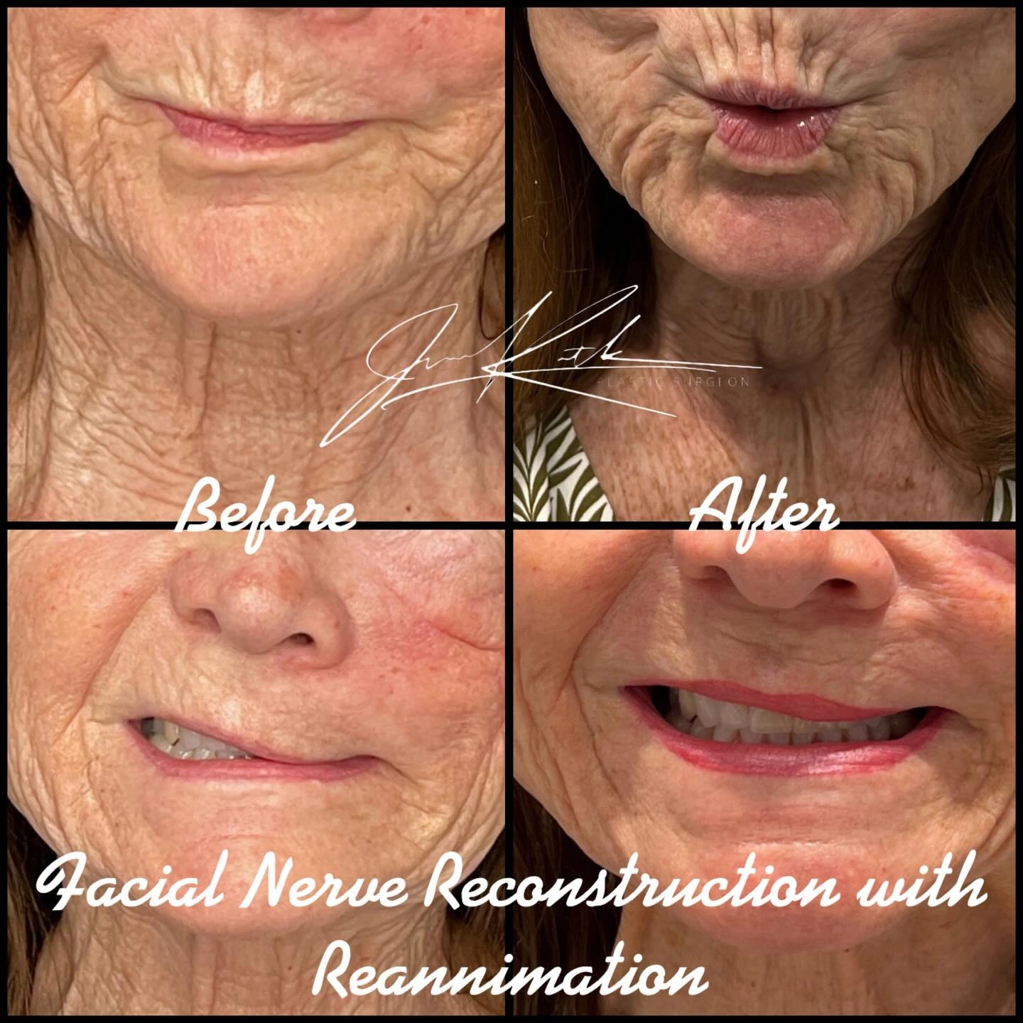 Facial nerve reconstruction with reanimation. Original clinical comparison from Envision Plastic Surgery.