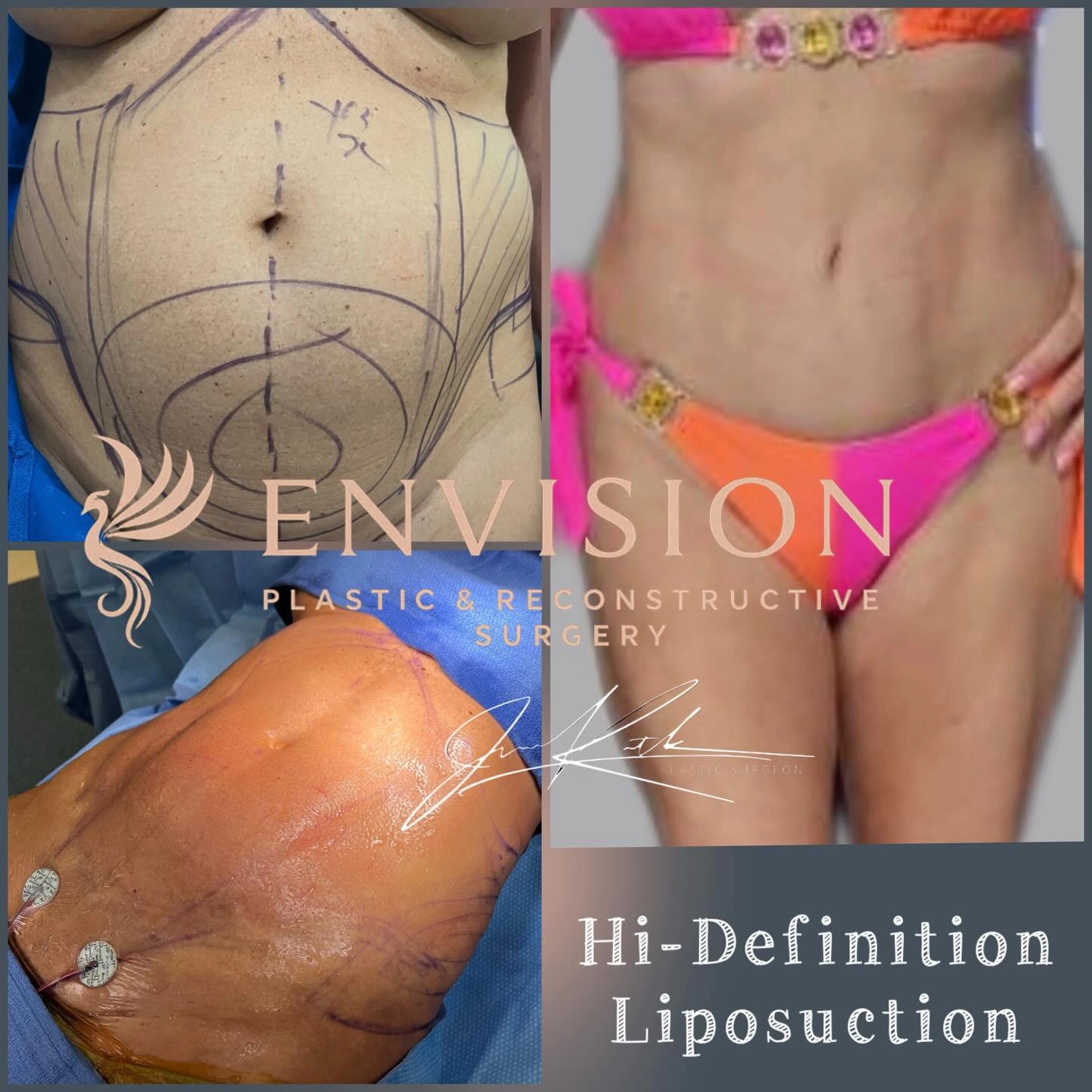 High-definition abdominal liposuction before-and-after comparison.