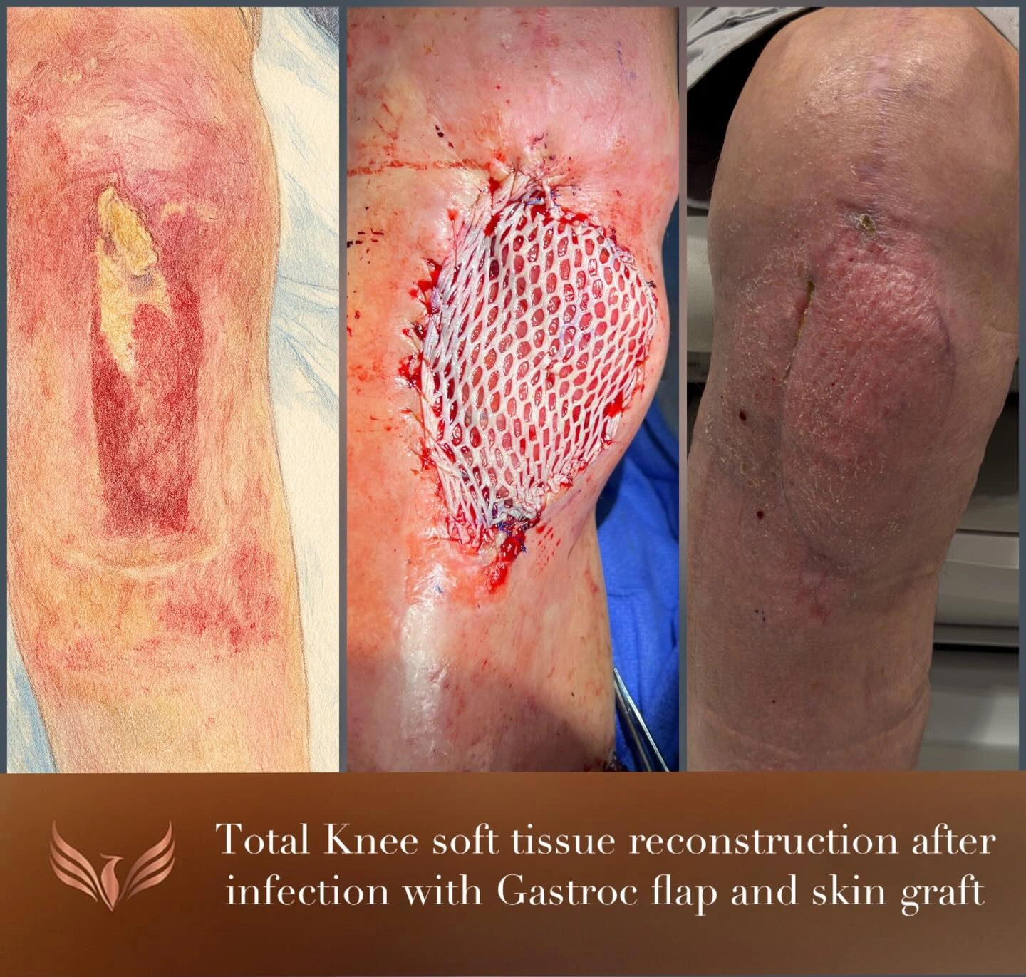 Knee soft-tissue reconstruction with gastrocnemius flap and skin graft. Original clinical comparison from Envision Plastic Surgery.