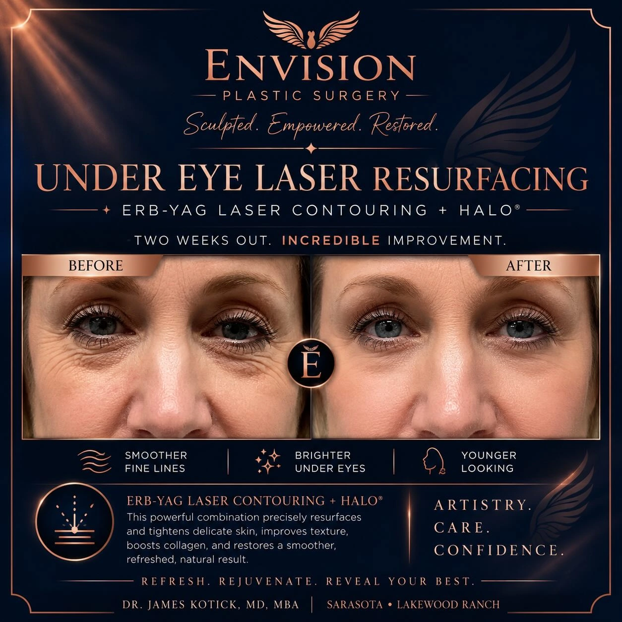 Under-eye laser resurfacing before and two weeks after treatment, as labeled in the original post.