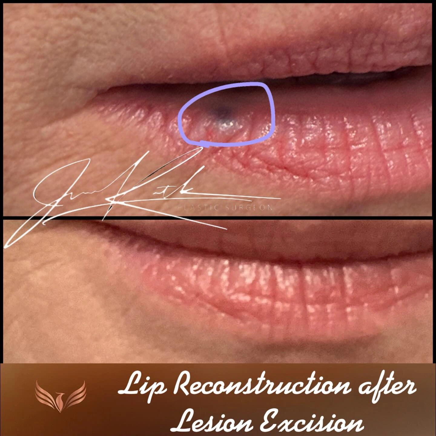 Lip reconstruction after lesion excision. Original clinical comparison from Envision Plastic Surgery.