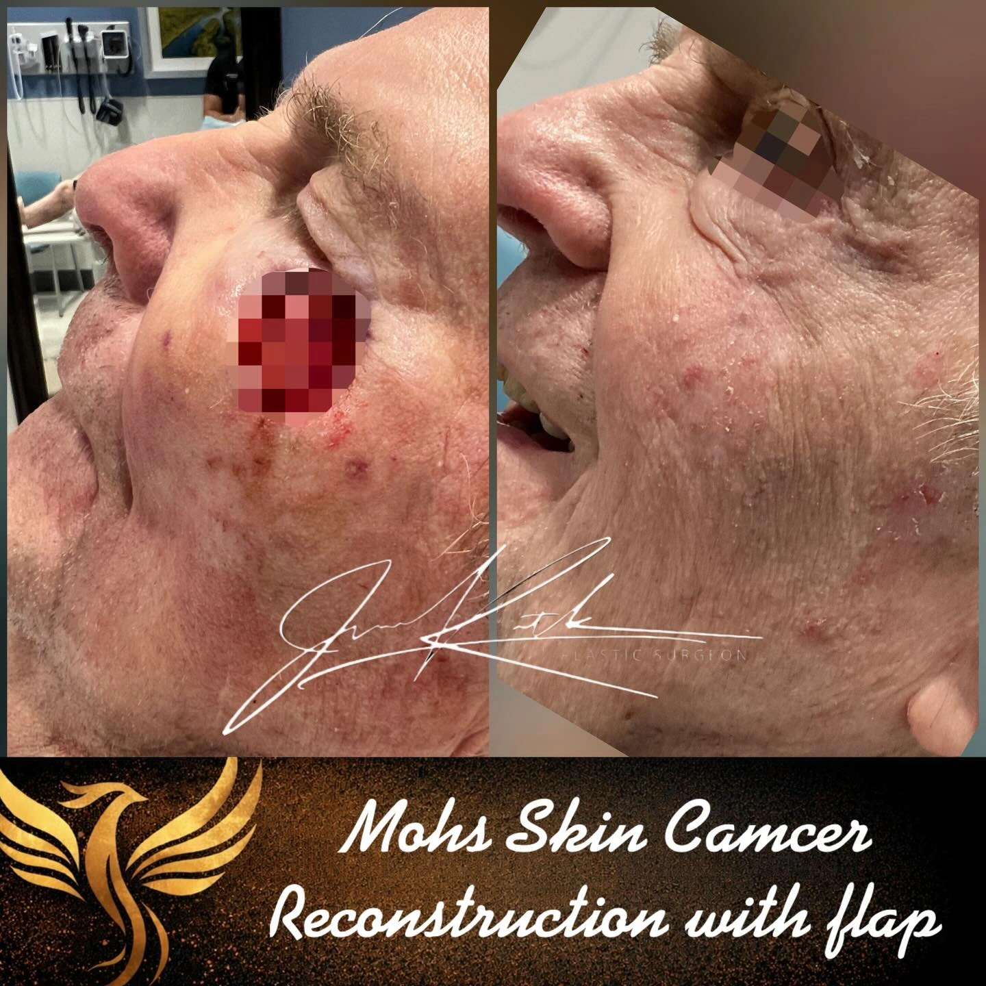 Cheek reconstruction after Mohs surgery with a flap. Original clinical comparison from Envision Plastic Surgery.
