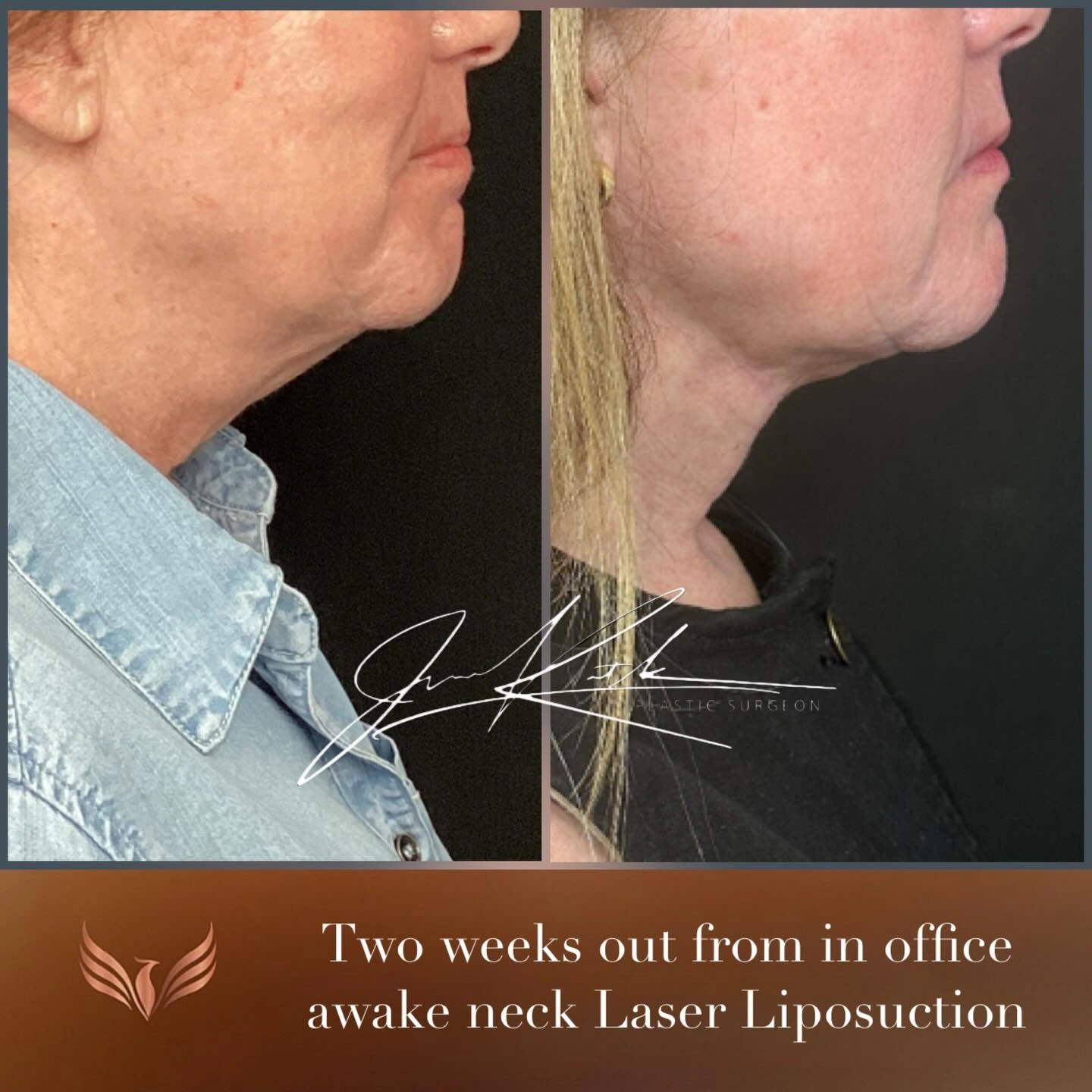 Awake neck laser liposuction · Two weeks after treatment. Original clinical comparison from Envision Plastic Surgery.