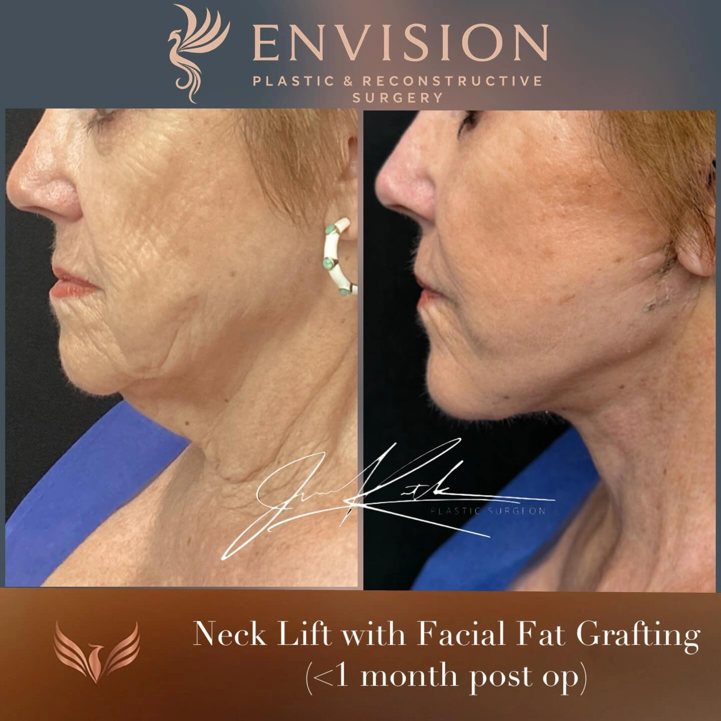 Neck lift with facial fat grafting · Less than one month after surgery. Original clinical comparison from Envision Plastic Surgery.