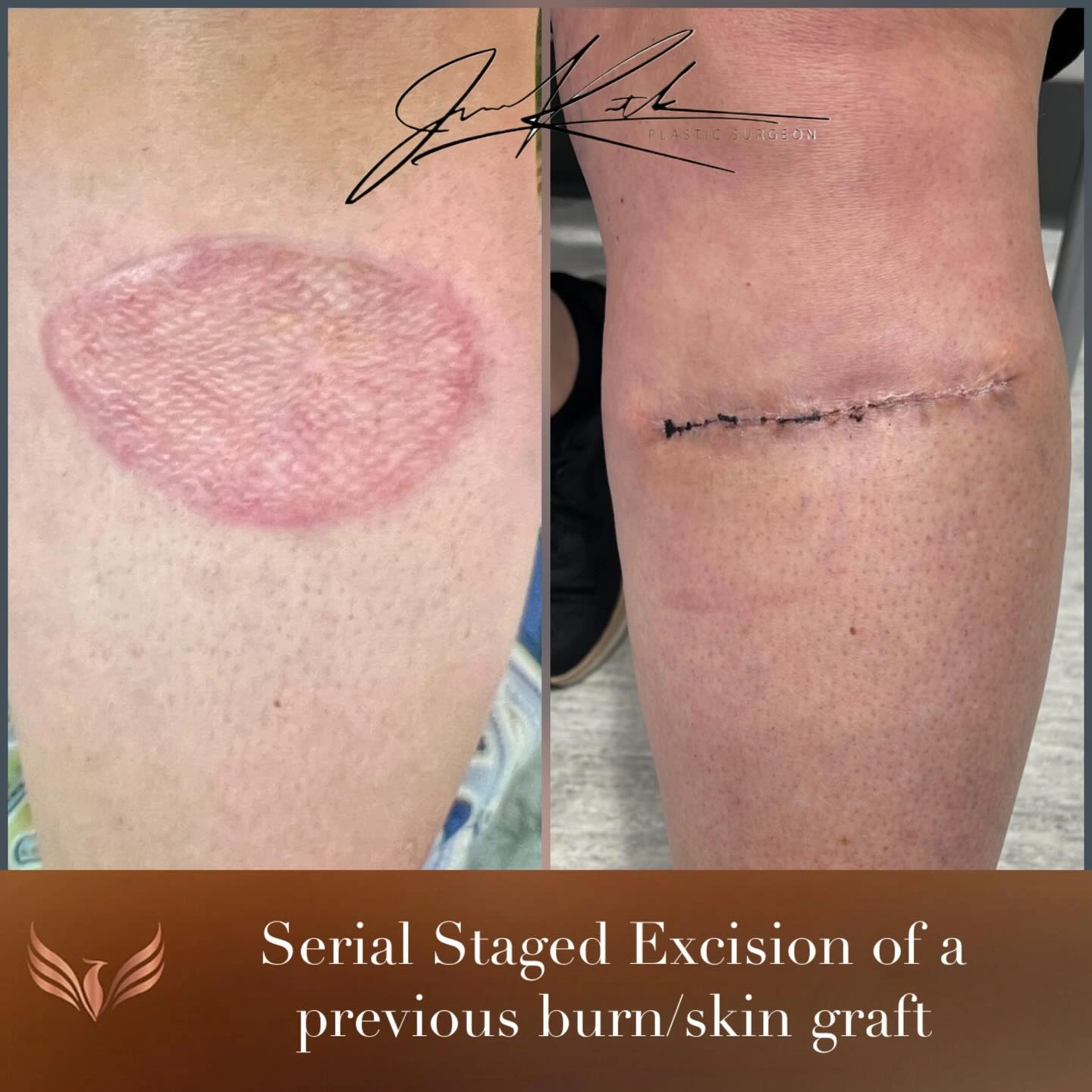 Staged excision of a previous burn / skin graft scar. Original clinical comparison from Envision Plastic Surgery.